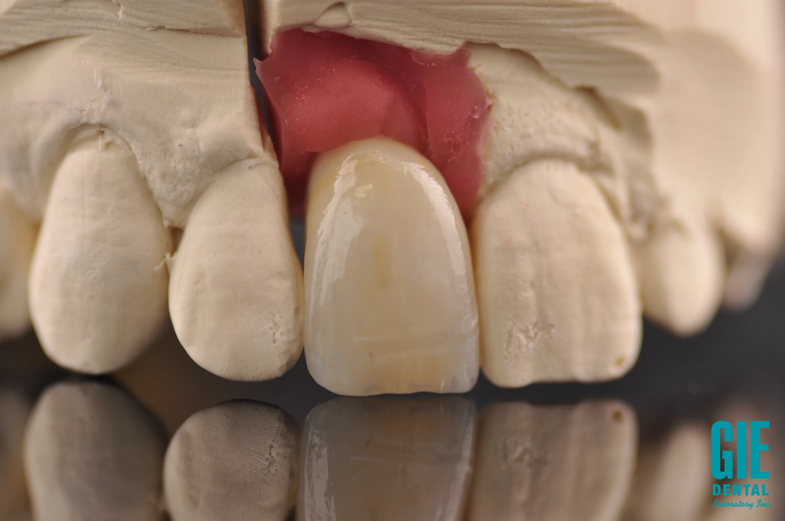 Screw-retained anterior crown