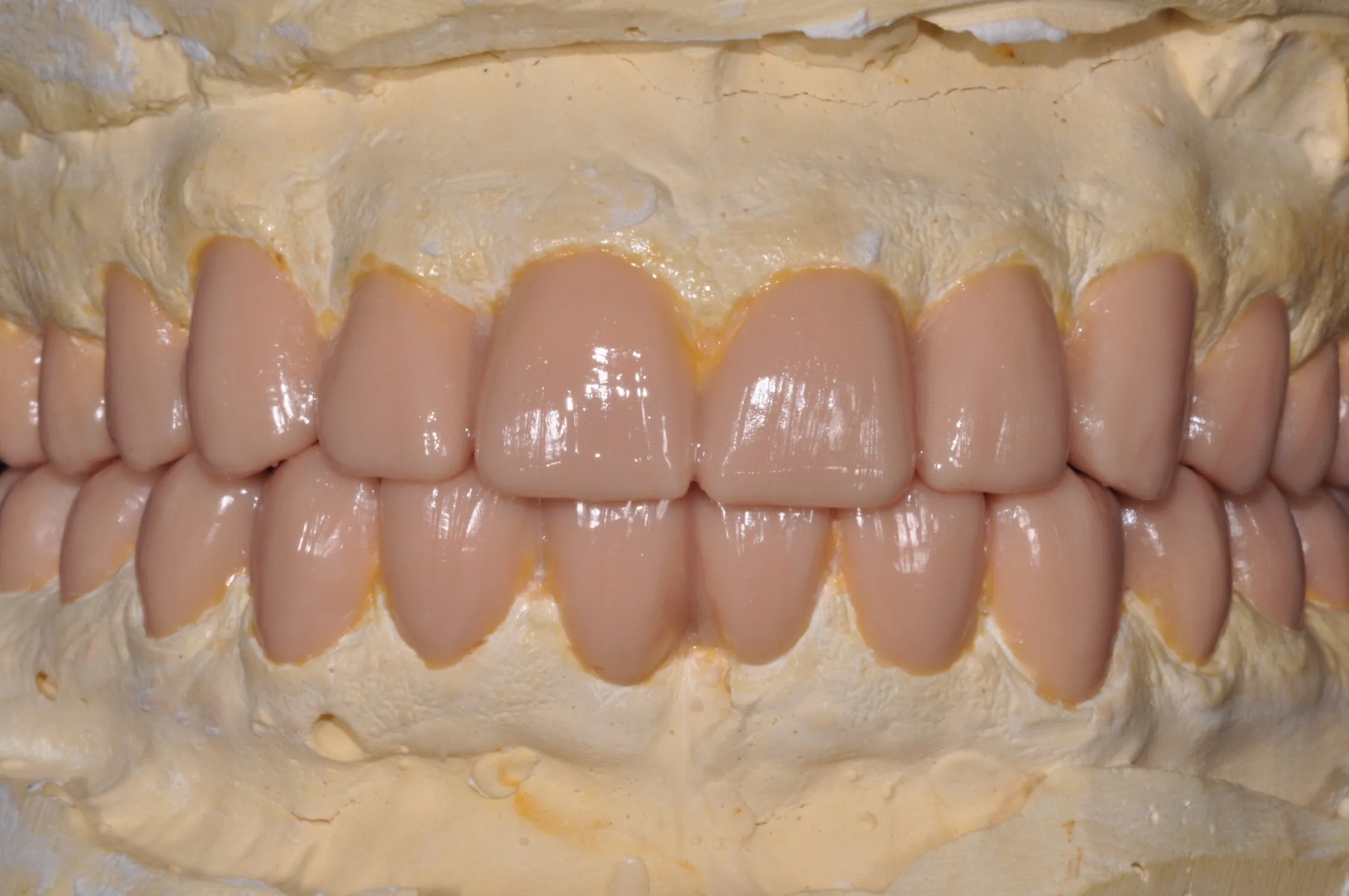 Diagnostic wax-up