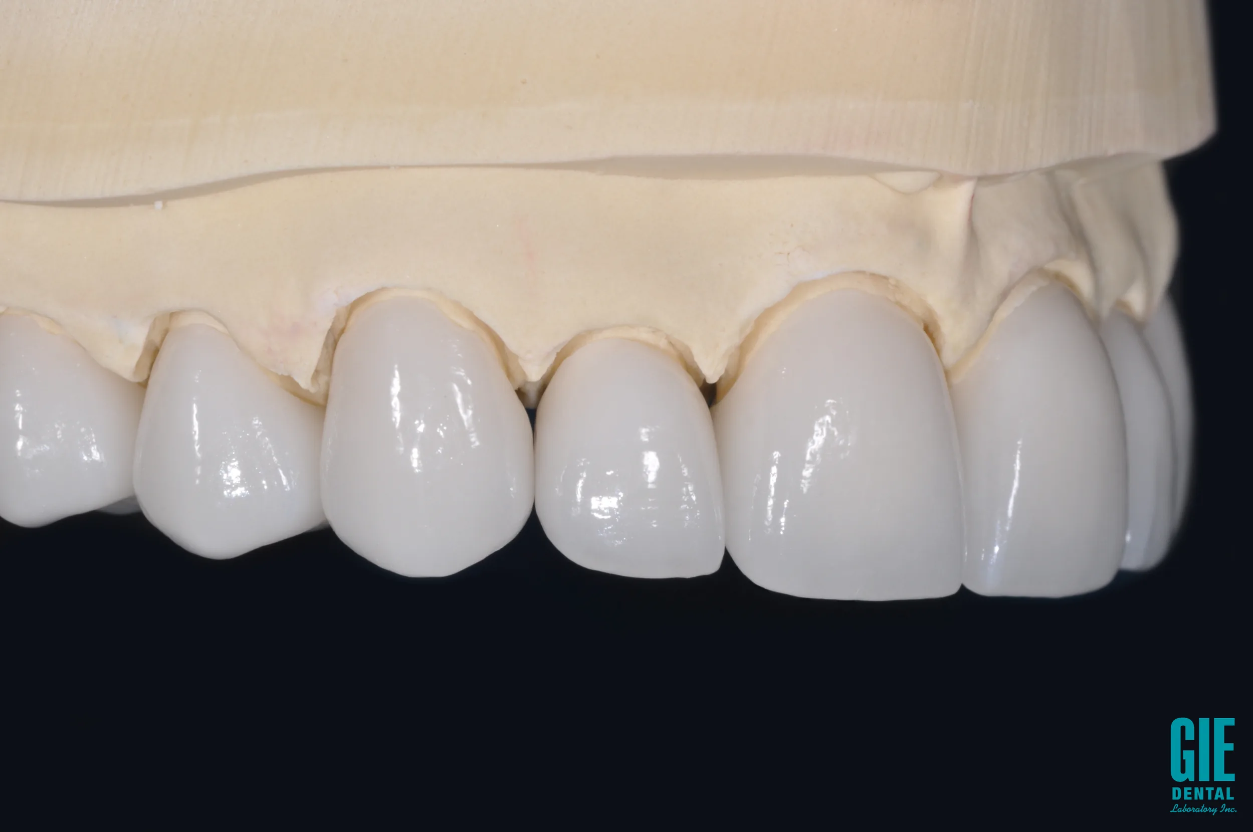 e.max posterior crown