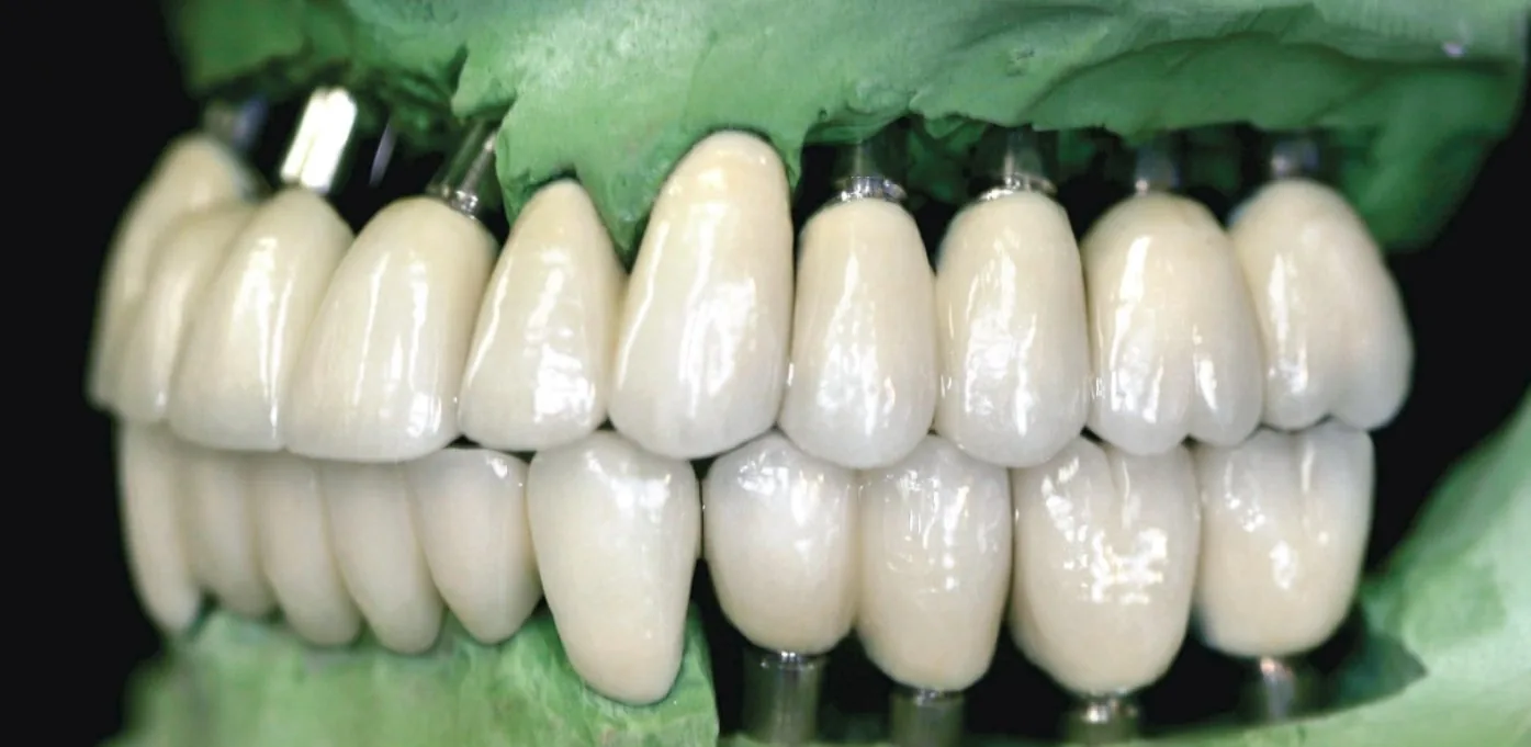 Full-mouth implant rehabilitation