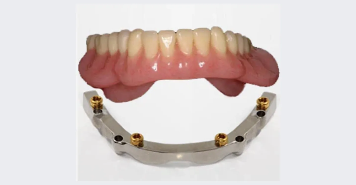 Seated locator bar overdenture