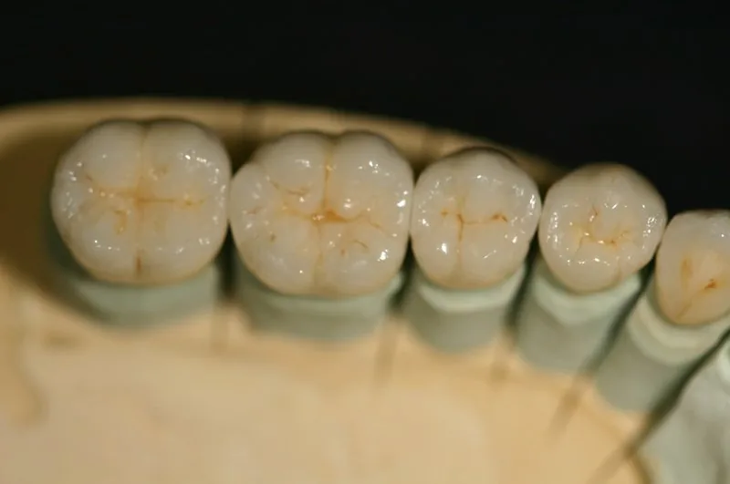 Porcelain-fused-to-metal crown