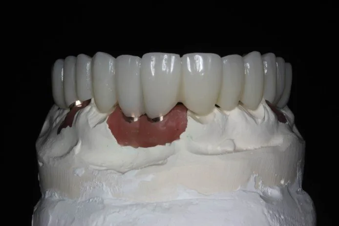 Maxillary implant PMMA provisional