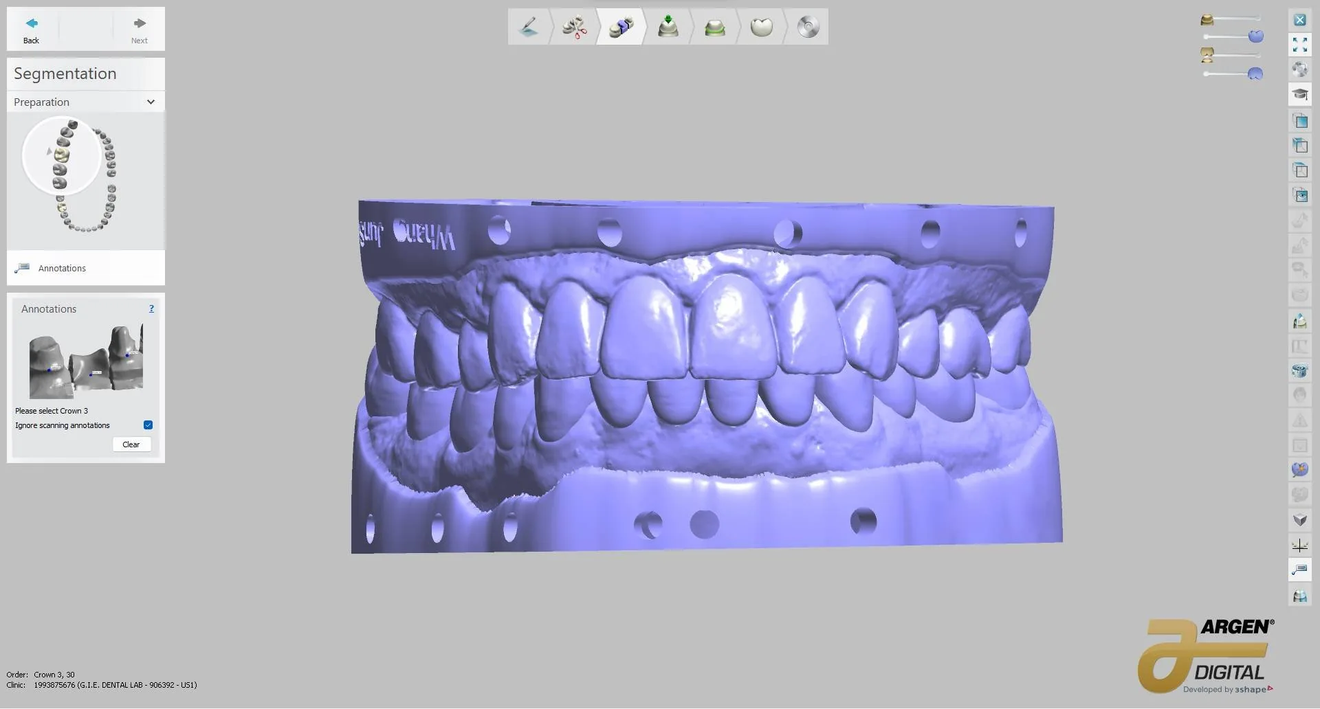 Full digital wax-up, after