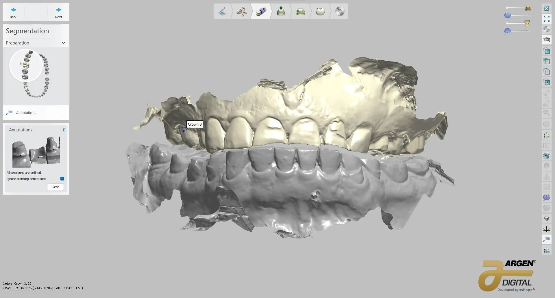 Full digital wax-up, before