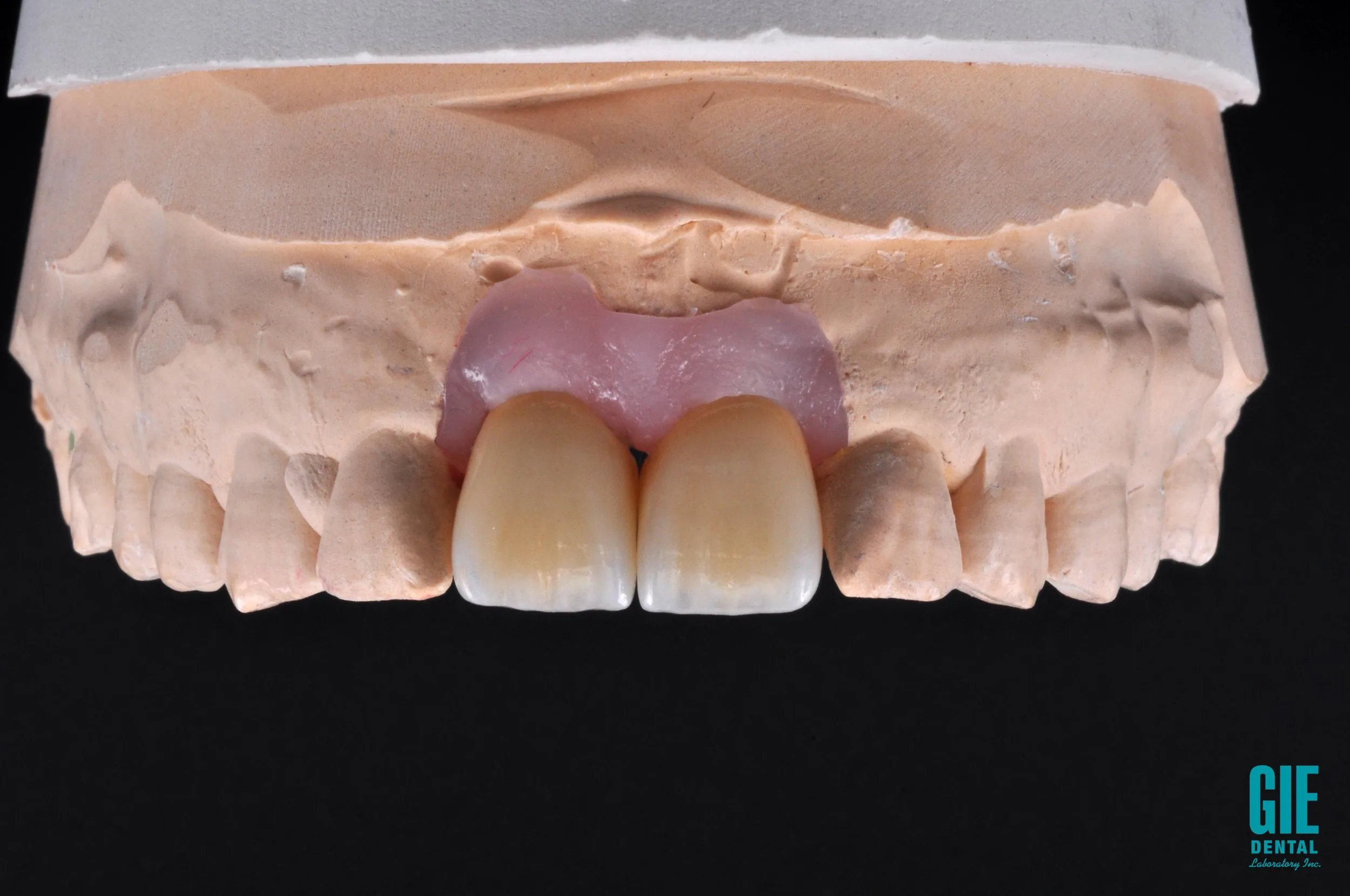 GIE Z-Ceram incisal restoration
