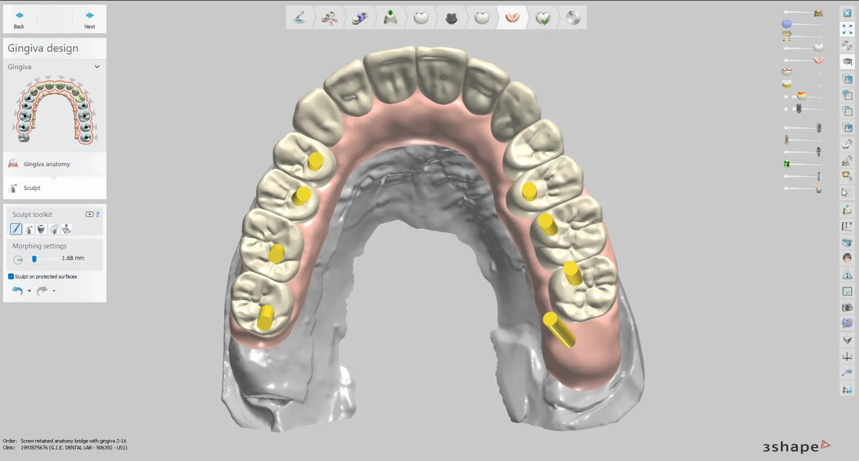 3Shape full-arch implant design