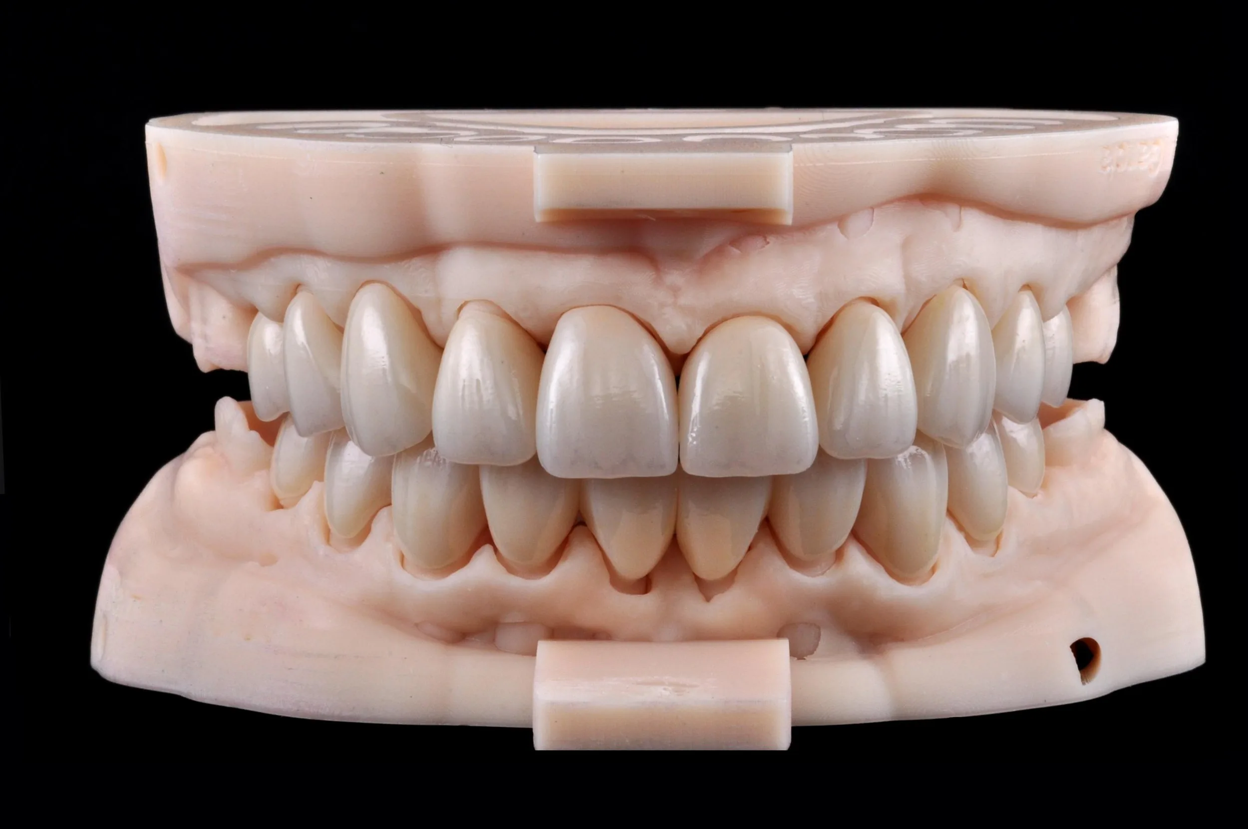 Upper and lower 20-unit full-zirconia implant restoration crafted at GIE Dental Lab